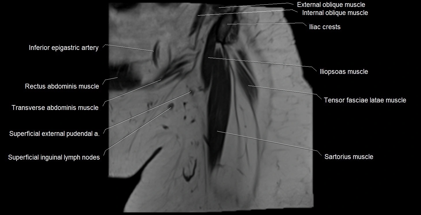 MRI Hip 3T coronal cross sectional anatomy image 2.webp
